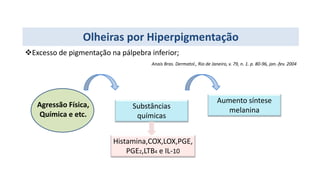 Olheiras por Hiperpigmentação
Excesso de pigmentação na pálpebra inferior;
Anais Bras. Dermatol., Rio de Janeiro, v. 79, n. 1. p. 80-96, jan.-fev. 2004
Substâncias
químicas
Histamina,COX,LOX,PGE,
PGE2,LTB4 e IL-10
Aumento síntese
melanina
Agressão Física,
Química e etc.
 