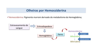 Olheiras por Hemossiderina
Hemossiderina: Pigmento marrom derivado do metabolismo da Hemoglobina;
Extravasamento de
sangue
Eritrodiapedese
Hemoglobina
Ferro
Hemossiderina
Biliverdina
Bilirrubina
Biliverdin reductase
Macrogagos
 