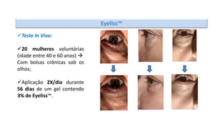 Eyeliss™
Teste In Vivo:
20 mulheres voluntárias
(idade entre 40 e 60 anos) 
Com bolsas crônicas sob os
olhos;
Aplicação 2X/dia durante
56 dias de um gel contendo
3% de Eyeliss™.
 