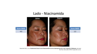 Antes Depois
Navarrete-Solís J, et al. Randomized Clinical Trial of Niacinamide 4% versus Hydroquinone 4% in the Treatment of Melasma. Dermatol
Res Pract. 2011;2011:379173. Epub 2011 Jul 21.
Lado - Niacinamida
Score MASI
4,0
Score MASI
1,2
 