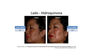 Navarrete-Solís J, et al. Randomized Clinical Trial of Niacinamide 4% versus Hydroquinone 4% in the Treatment of Melasma. Dermatol
Res Pract. 2011;2011:379173. Epub 2011 Jul 21.
Antes Depois
Lado - Hidroquinona
Score MASI
3,7
Score MASI
1,4
 