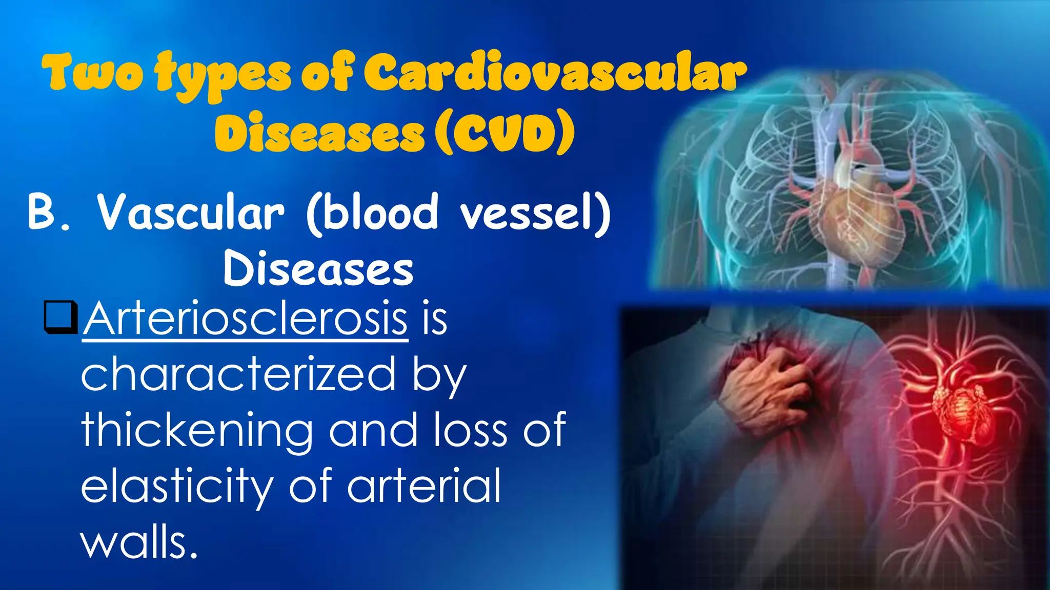 B. Vascular (blood vessel)
Diseases
Two types of Cardiovascular
Diseases (CVD)
Arteriosclerosis is
characterized by
thickening and loss of
elasticity of arterial
walls.
 