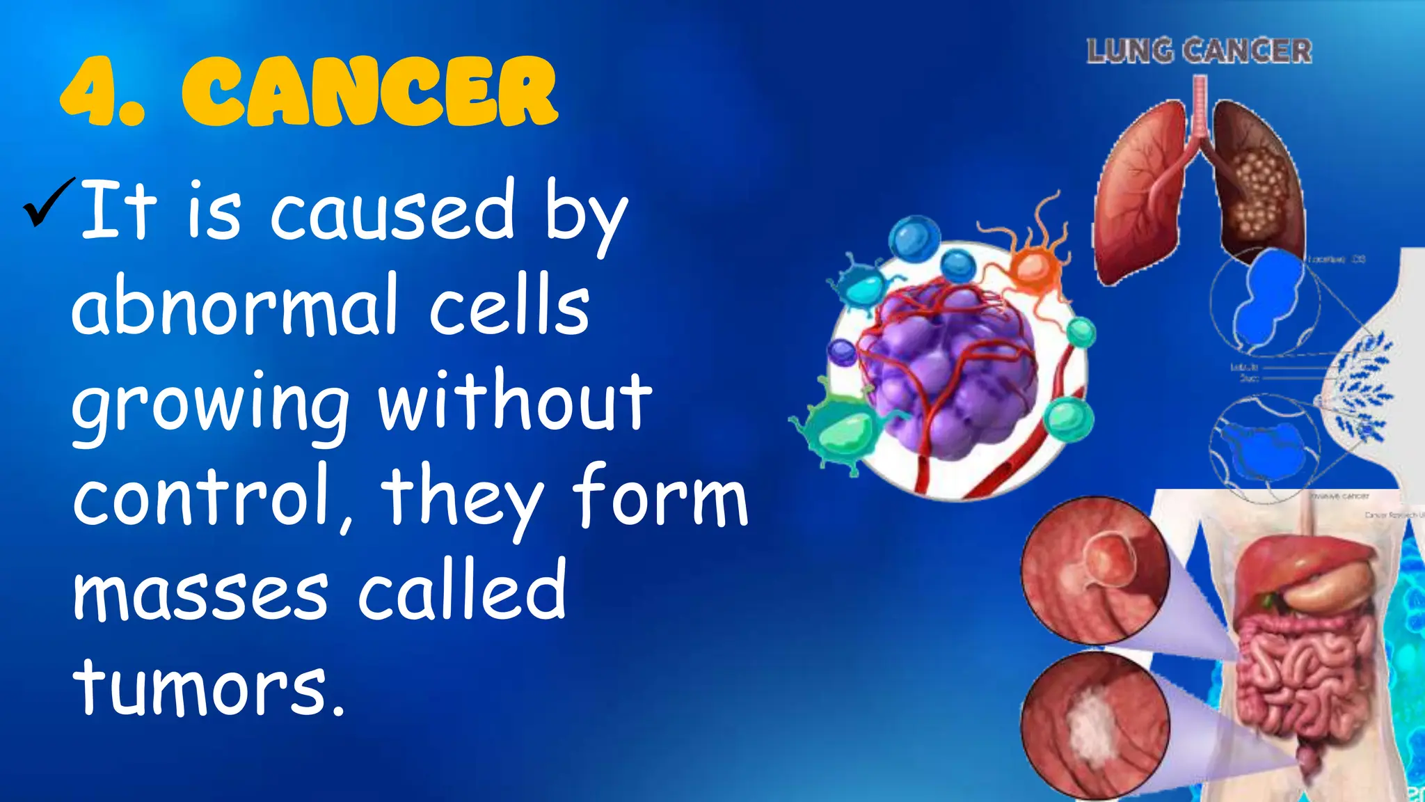It is caused by
abnormal cells
growing without
control, they form
masses called
tumors.
4. CANCER
 