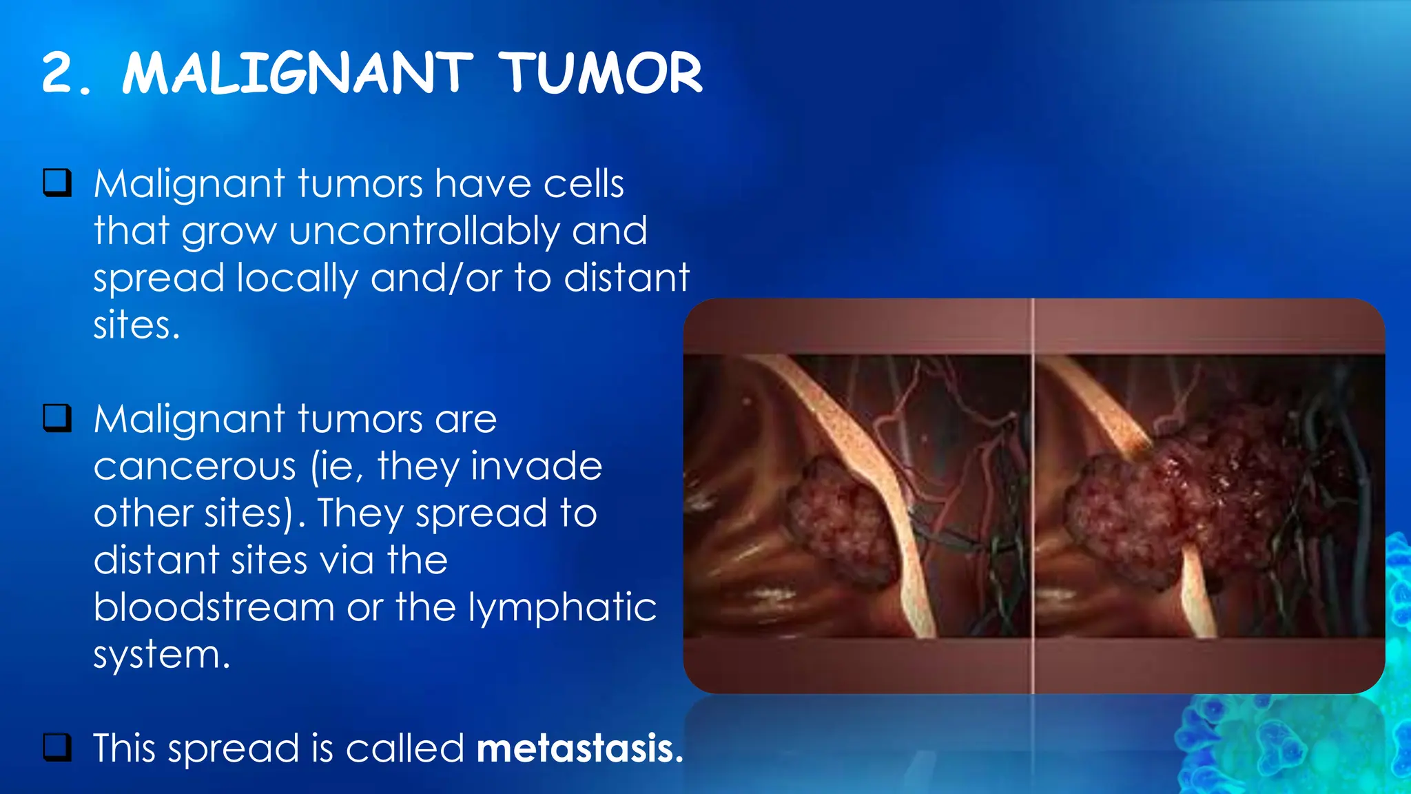 2. MALIGNANT TUMOR
 Malignant tumors have cells
that grow uncontrollably and
spread locally and/or to distant
sites.
 Malignant tumors are
cancerous (ie, they invade
other sites). They spread to
distant sites via the
bloodstream or the lymphatic
system.
 This spread is called metastasis.
 