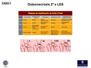 Osteonecrosis 2º a LESCASO 1
 