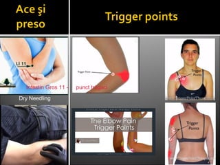 Dry Needling
Intestin Gros 11 - punct trăgaci
 