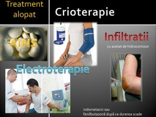 cu acetat de hidrocortizon
indometacin sau
fenilbutazonă după ce durerea scade
 