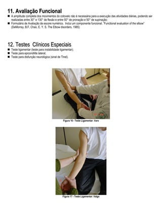 11. Avaliação Funcional
 A amplitude completa dos movimentos do cotovelo não é necessária para a execução das atividades diárias, podendo ser
 realizadas entre 30° e 130° de flexão e entre 50° de pronação e 50° de supinação;
 Formulário de Avaliação de escore numérico. Inclui um componente funcional. ”Functional evaluation of the elbow”
 (DeMorrey, B.F, Chao, E. Y. S. The Elbow disorders, 1985)




12. Testes Clínicos Especiais
 Teste ligamentar (teste para instabilidade ligamentar);
 Teste para epicondilite lateral;
 Teste para disfunção neurológica (sinal de Tinel).




                                              Figura 16 - Teste Ligamentar: Varo




                                              Figura 17 - Teste Ligamentar: Valgo
 