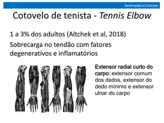Cotovelo de tenista - Tennis Elbow
1 a 3% dos adultos (Altchek et al, 2018)
Sobrecarga no tendão com fatores
degenerativos e inflamatórios
Extensor radial curto do
carpo; extensor comum
dos dedos, extensor do
dedo mínimo e extensor
ulnar do carpo
Tendinopatia no Cotovelo
 