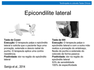 Teste de Cozen
Execução: O terapeuta palpa o epicôndilo
lateral e solicita que o paciente faça uma
pronação, extensão e desvio radial do
punho. O terapeuta aplica uma contra
resistência.
Positividade: dor na região do epicôndilo
lateral
Teste de Mill
Execução: O terapeuta palpa o
epicôndilo lateral e com a outra mão
realiza a pronação do antebraço,
flexão do punho e extensão do
cotovelo de forma passiva
Positividade: dor na região do
epicôndilo lateral
53% de sensibilidade
100% de especificidade
Epicondilite lateral
Tendinopatia no cotovelo-Testes Clínicos
Saroja et al., 2014
 