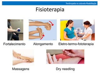 Fisioterapia
Fortalecimento Alongamento Eletro-termo-fototerapia
Massagens Dry needling
Tendinopatia no cotovelo-Reabilitação
 