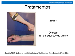 Tratamentos
Órteses
15° de extensão de punho
Capitulo 78-87 de Skirven et al. Rehabilitation of the Hand and Upper Extremity. 6° ed. 2002
Brace
Tendinopatia no cotovelo-Reabilitação
 