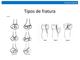 Tipos de fratura
Fratura de Cotovelo
 