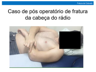 Caso de pós operatório de fratura
da cabeça do rádio
Fratura de Cotovelo
 