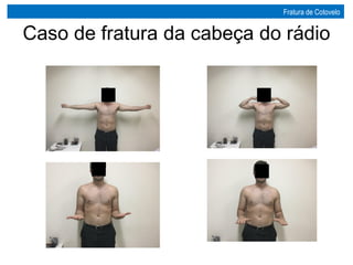 Caso de fratura da cabeça do rádio
Fratura de Cotovelo
 