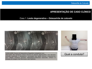 Caso 1. Lesão degenerativa – Osteoartrite de cotovelo
APRESENTAÇÃO DE CASO CLÍNICO
Qual a conduta?
Osteoartite de Cotovelo
 