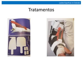 Tratamentos
Lesões Esportivas no Cotovelo
 