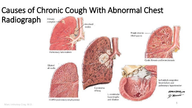 eosinophilic pneumonia vicodin eosinophilic pneumonia vicodin