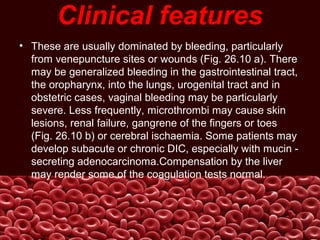 Clinical features
• These are usually dominated by bleeding, particularly
from venepuncture sites or wounds (Fig. 26.10 a). There
may be generalized bleeding in the gastrointestinal tract,
the oropharynx, into the lungs, urogenital tract and in
obstetric cases, vaginal bleeding may be particularly
severe. Less frequently, microthrombi may cause skin
lesions, renal failure, gangrene of the fingers or toes
(Fig. 26.10 b) or cerebral ischaemia. Some patients may
develop subacute or chronic DIC, especially with mucin -
secreting adenocarcinoma.Compensation by the liver
may render some of the coagulation tests normal.
 