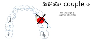 នឹងគឺមិនហមន couple ធ្ទ
That is not couple or
coupling in orthodontics
 