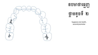 ឧបមាថាធ្មេញ
ថាា មតូចទី ២
Suppose one tooth,
second premolar
 