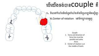 ធ្បើធ្យើងចង់បានcouple គឺ
១. ទិសធ្ៅកំលំងនិងចំនួនកំលំងទាំងពីរត្សបគ្នា និងធ្សេើរគ្នា
២.​
Center of rotation ធ្ៅចំកណ្ត
ត លធ្មេញ
Couple
1. Force and direction of
force line must be
parallel and same
force.
2. Center of rotation is at
the middle of tooth.
 