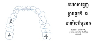 ឧបមាថាធ្មេញ
ថាា មតូចទី ២
បានវិលពីមុនមក
Suppose one tooth,
second premolar that has
rotated.
 
