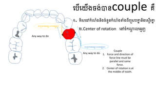 ធ្បើធ្យើងចង់បានcouple គឺ
១. ទិសធ្ៅកំលំងនិងចំនួនកំលំងទាំងពីរត្សបគ្នា និងធ្សេើរគ្នា
២.​
Center of rotation ធ្ៅចំកណ្ត
ត លធ្មេញ
CR
ទាញតាមមធ្មោបាយធ្សេងៗ
ទាញតាមមធ្មោបាយធ្សេងៗ
Couple
1. Force and direction of
force line must be
parallel and same
force.
2. Center of rotation is at
the middle of tooth.
Any way to do
Any way to do
 