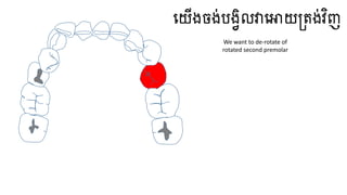 ធ្យើងចង់បងវិលវាធ្ោយត្តង់វិញ
We want to de-rotate of
rotated second premolar
 