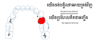 ធ្យើងចង់បងវិលវាធ្ោយត្តង់វិញ
ធ្យើងត្បហែលគិតថាអញ្ចឹង
We want to de-rotate of
rotated second premolar
We might be think that
 