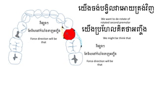ធ្យើងចង់បងវិលវាធ្ោយត្តង់វិញ
ធ្យើងត្បហែលគិតថាអញ្ចឹង
រឺធ្សេងៗ
ហតទិសធ្ៅកំលំងទាញអញ្ចឹង
រឺធ្សេងៗ
ហតទិសធ្ៅកំលំងទាញអញ្ចឹង
We want to de-rotate of
rotated second premolar
We might be think that
Force direction will be
that
Force direction will be
that
 