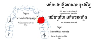 ធ្យើងចង់បងវិលវាធ្ោយត្តង់វិញ
ធ្យើងត្បហែលគិតថាអញ្ចឹង
រឺធ្សេងៗ
ហតទិសធ្ៅកំលំងទាញអញ្ចឹង
រឺធ្សេងៗ
ហតទិសធ្ៅកំលំងទាញអញ្ចឹង
We want to de-rotate of
rotated second premolar
We might be think that
Force direction will be
that
Force direction will be
that
 