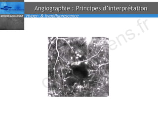 Angiographie : Principes d’interprétation Hyper- & hypofluorescence 
