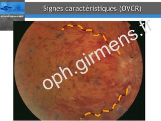 Signes caractéristiques (OVCR) oph.girmens.fr 