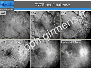 OVCR oedémateuse 15 s vert 18 s 23 s 5 min Evolution à 3 mois oph.girmens.fr 