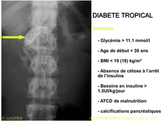 DIABETE TROPICAL
Définition
- Glycémie > 11.1 mmol/l
- Age de début < 30 ans
- BMI < 19 (18) kg/m²
- Absence de cétose à l’arrêt
de l’insuline
- Besoins en insuline >
1.5UI/kg/jour
- ATCD de malnutrition
- calcifications pancréatiques
ALBERTI KGMM in Diabetes in Africa, 1997
J-F. GAUTIER
 
