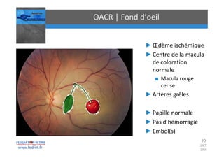 Occlusions vasculaires retiniennes