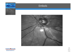 Occlusions vasculaires retiniennes