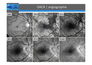 Occlusions vasculaires retiniennes