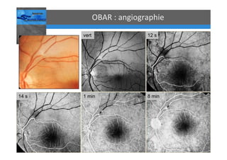 Occlusions vasculaires retiniennes