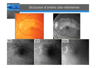 Occlusions vasculaires retiniennes