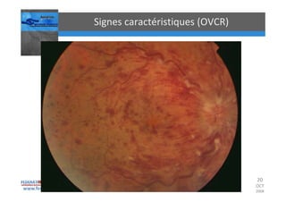 Occlusions vasculaires retiniennes