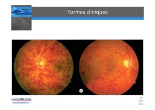 Occlusions vasculaires retiniennes