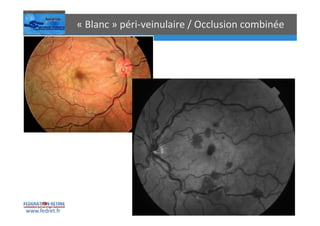 Occlusions vasculaires retiniennes