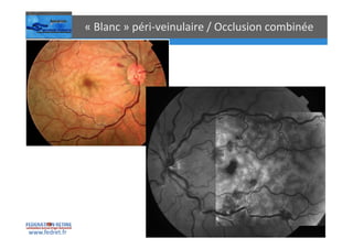 Occlusions vasculaires retiniennes