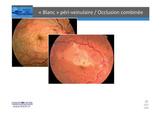 Occlusions vasculaires retiniennes
