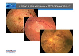 Occlusions vasculaires retiniennes