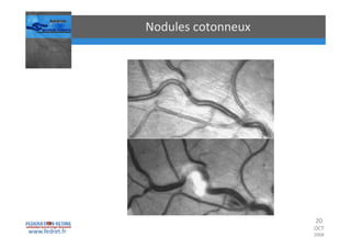 Occlusions vasculaires retiniennes