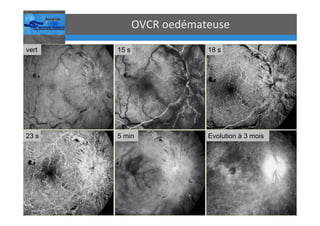 Occlusions vasculaires retiniennes