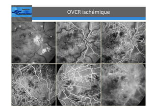 Occlusions vasculaires retiniennes